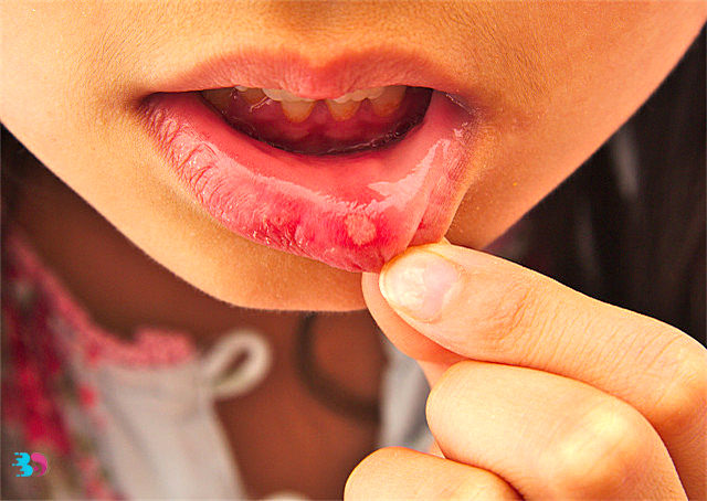 口腔溃疡是什么症状