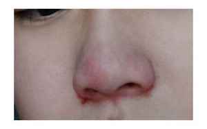 草莓鼻
