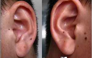 耳朵有痣代表什么