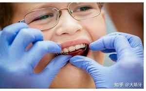 牙齿矫正能影响运势吗